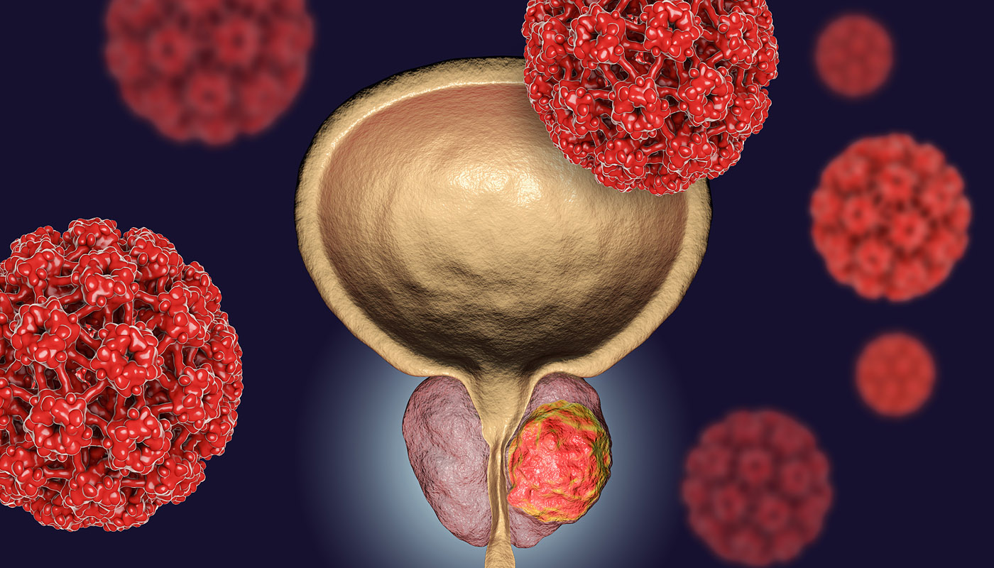 Cáncer de Próstata